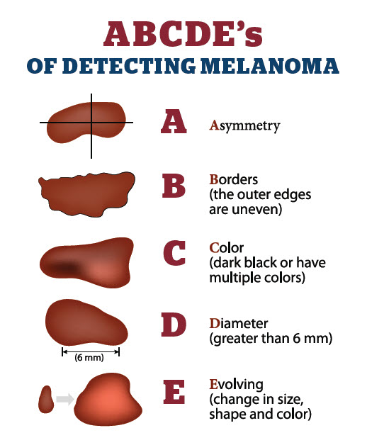 ABCDE's of Detecting Melanoma